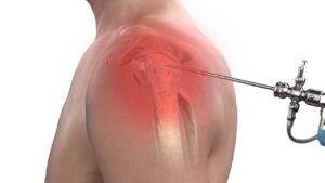 Artroskopia barku Szczecin