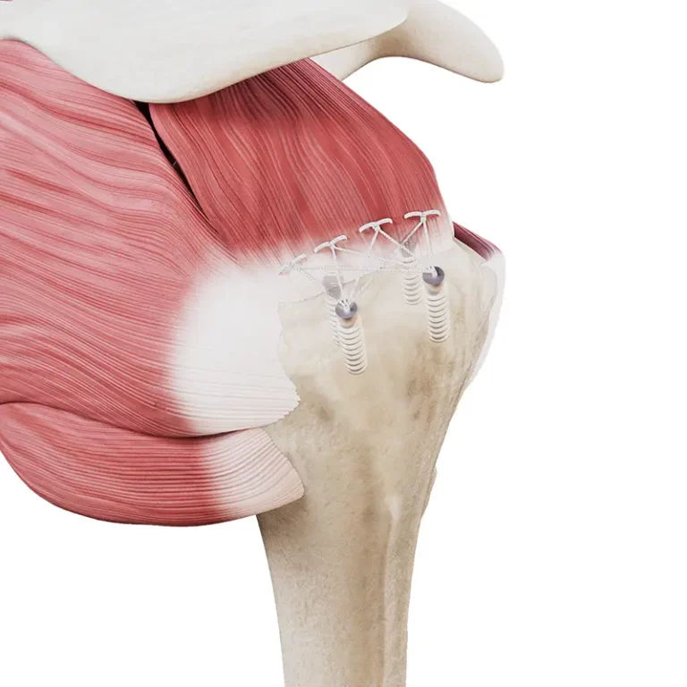 Artroskopowa naprawa ścięgien - dwurzędowa