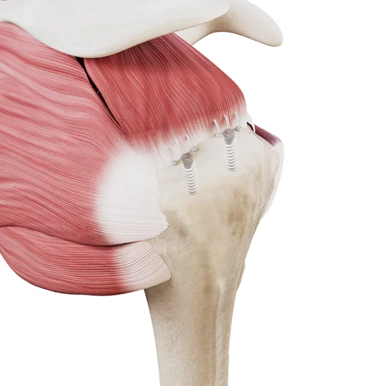 Artroskopowa naprawa ścięgien - jednorzędowa