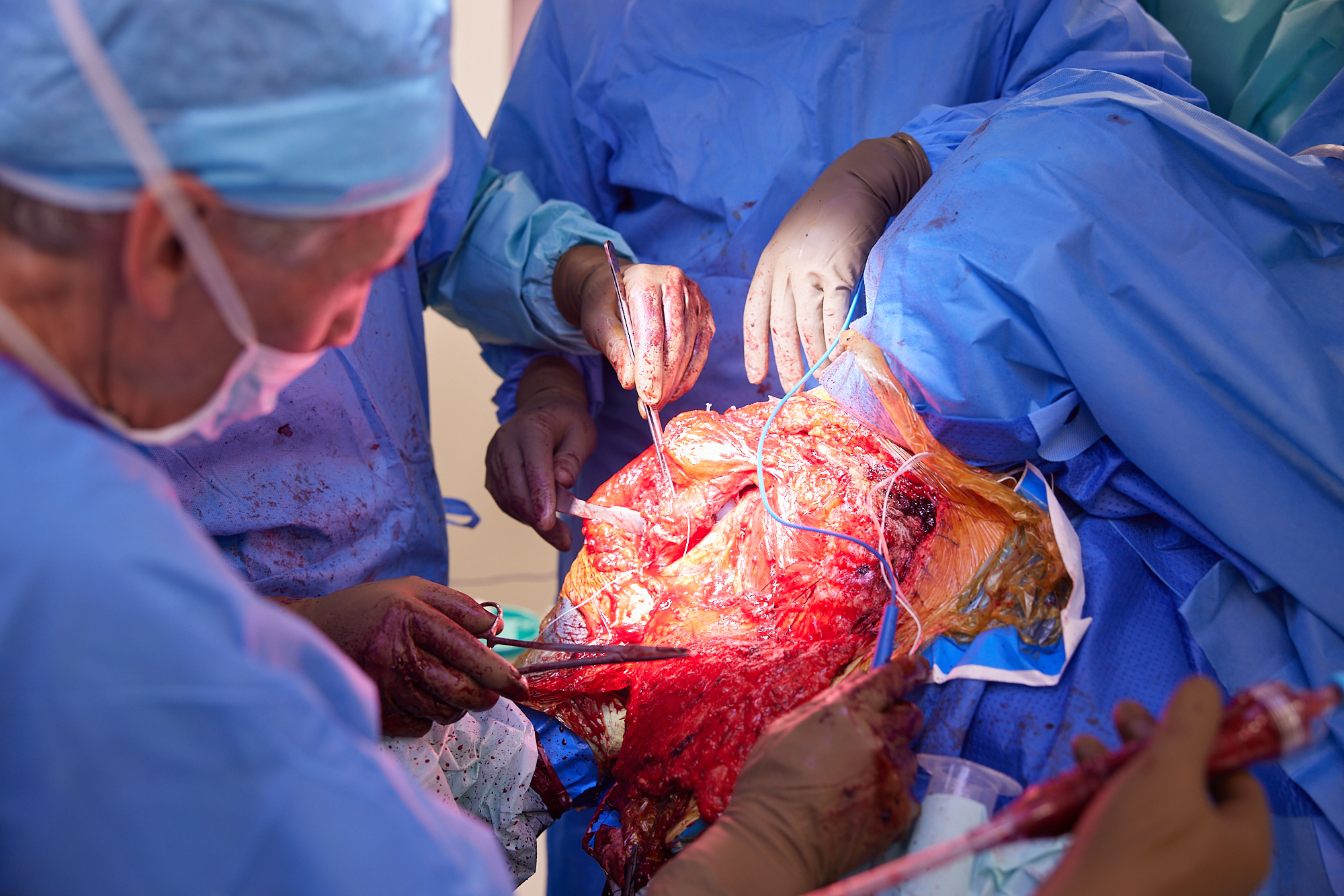 Pole operacyjne podczas transferu mięśnia piersiowego większego - widoczny preparowany pęczek naczyniowo-nerwowy