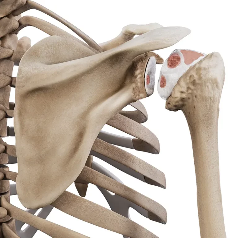 Niewapniejące zapalenie ścięgien stożka rotatorów