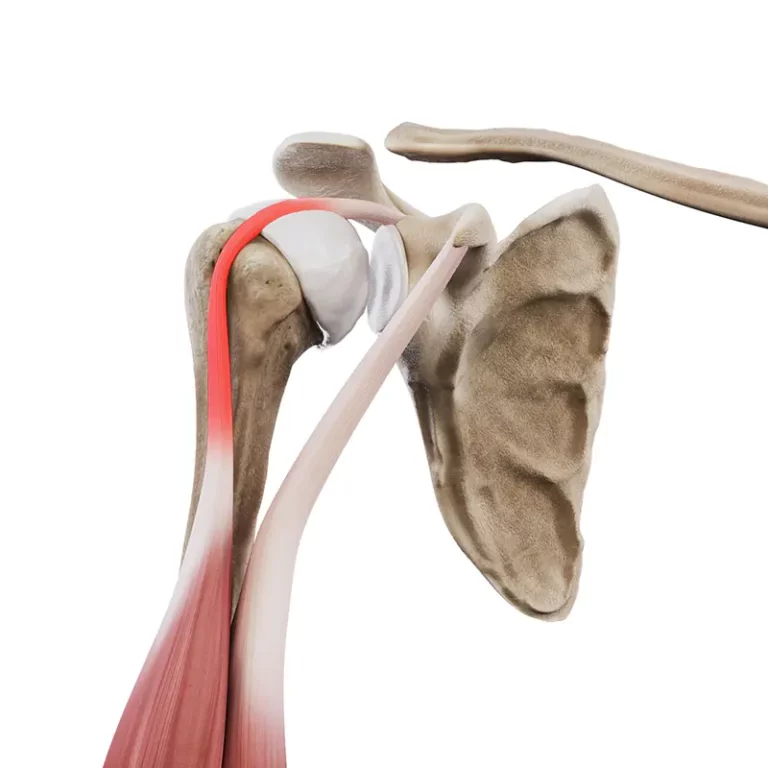 Patologie głowy długiej bicepsa - zapalenie