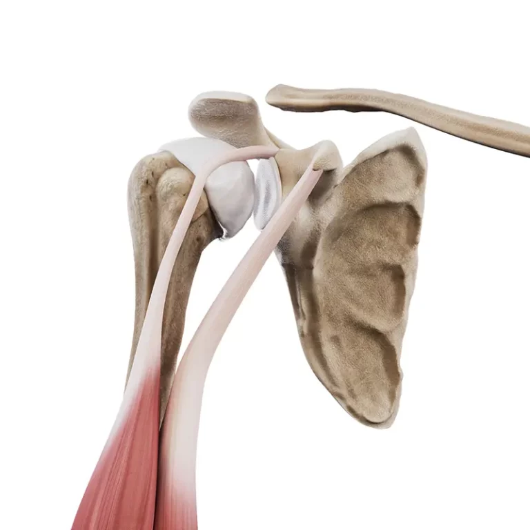 Patologie głowy długiej bicepsa - zwichnięcie