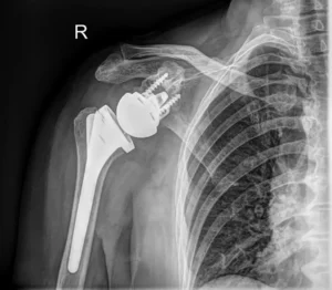 Proteza stawu ramiennego