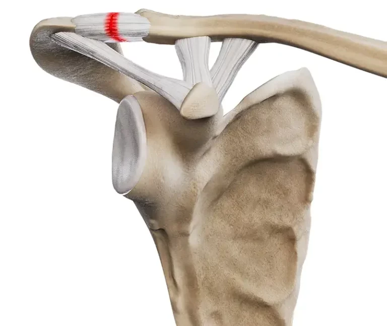 Urazy stawu barkowo-obojczykowego - stopień I