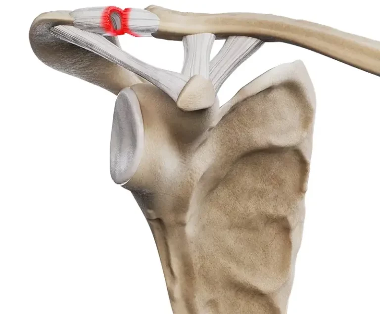 Urazy stawu barkowo-obojczykowego - stopień II