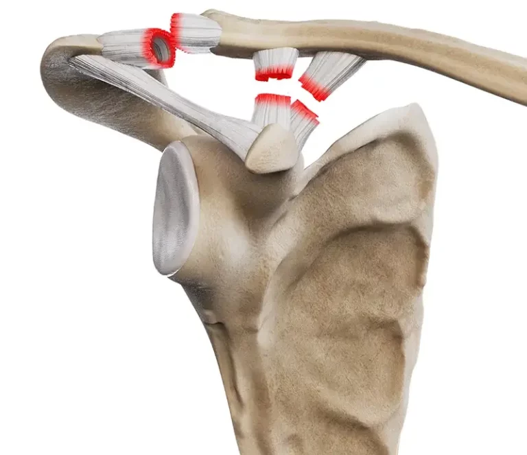 Urazy stawu barkowo-obojczykowego - stopień III