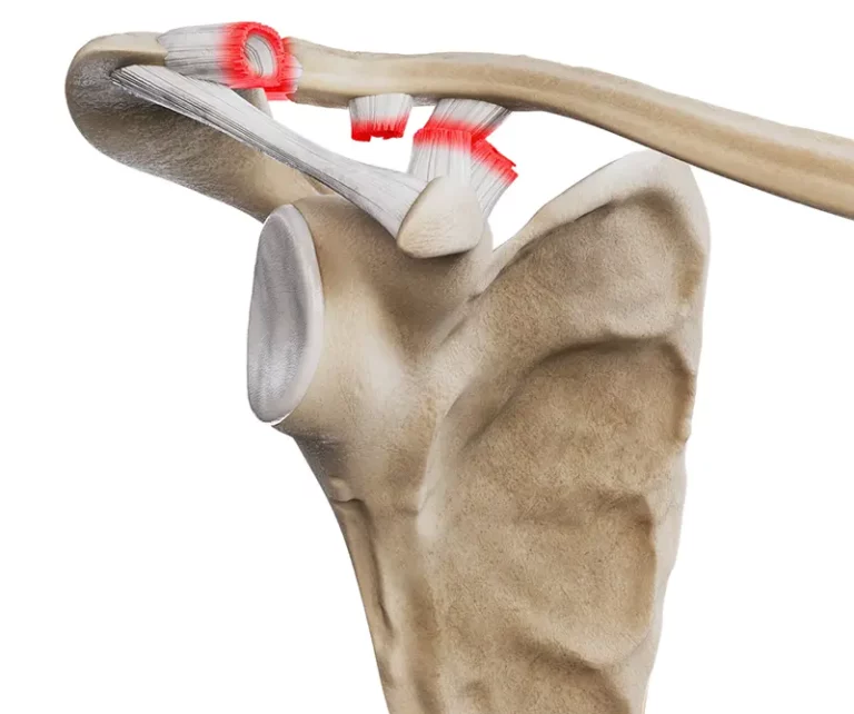 Urazy stawu barkowo-obojczykowego - stopień IV