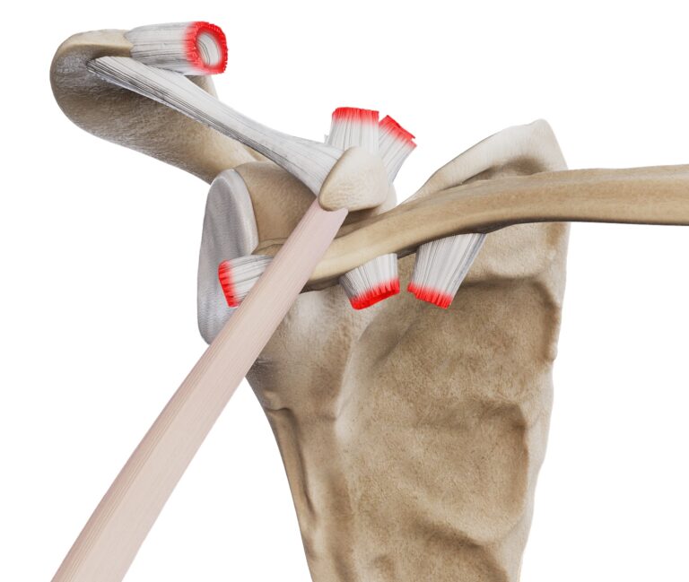 Urazy stawu barkowo-obojczykowego - stopień VI
