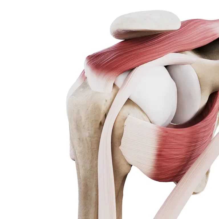 Uszkodzenie ścięgien stożka stawu barkowego typ L