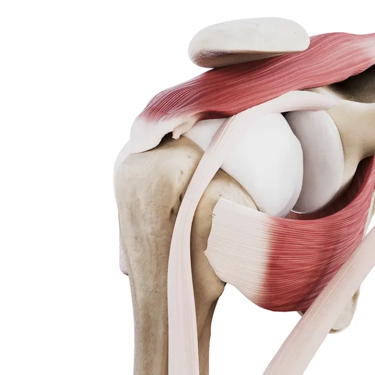 Uszkodzenie ścięgien stożka stawu barkowego typ L odwrócony