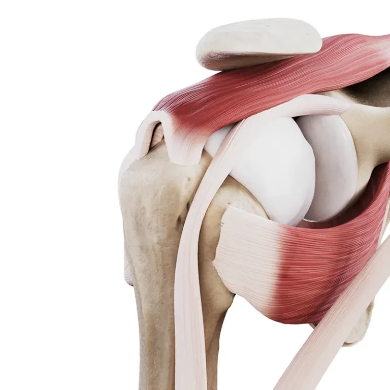 Uszkodzenie ścięgien stożka stawu barkowego typ U