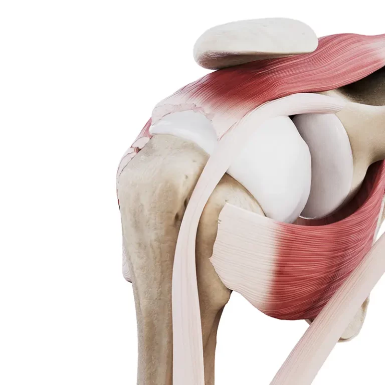 Masywne uszkodzenie ścięgien stożka stawu barkowego