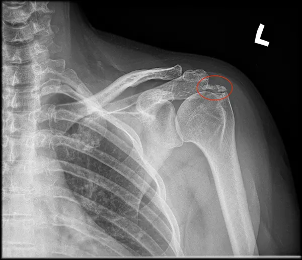 Wapniejące zapalenie ścięgien stożka rotatorów